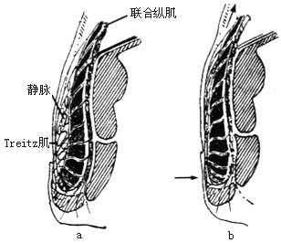 肛瘘的治疗