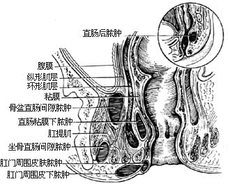 肛周脓肿科普示意图