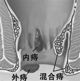 混合痔常用的治疗方法