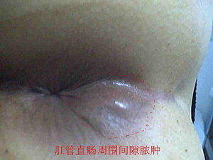肛周脓肿技术新指标