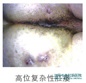 高位复杂性肛瘘图片